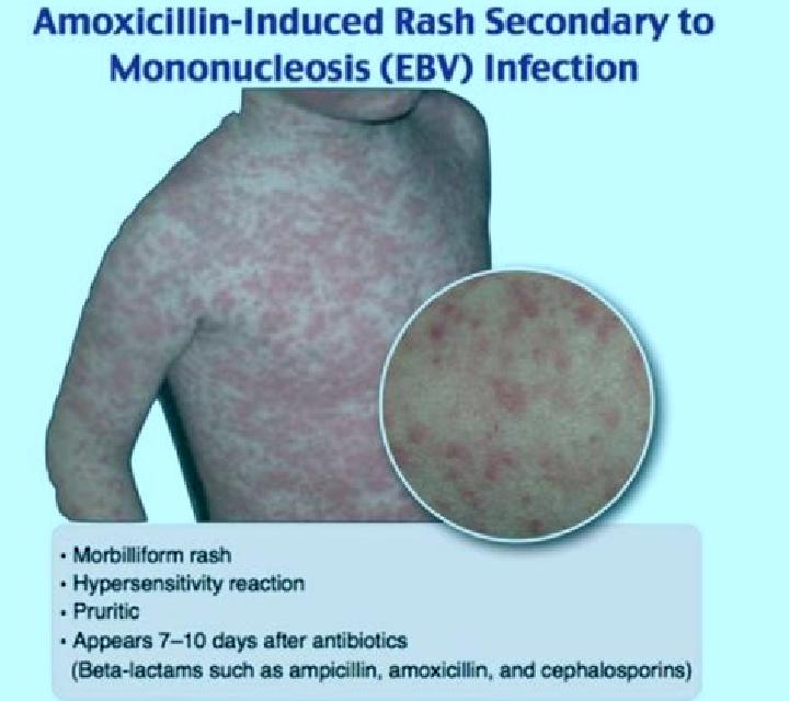 Flagyl contraindications with flagyl tablet